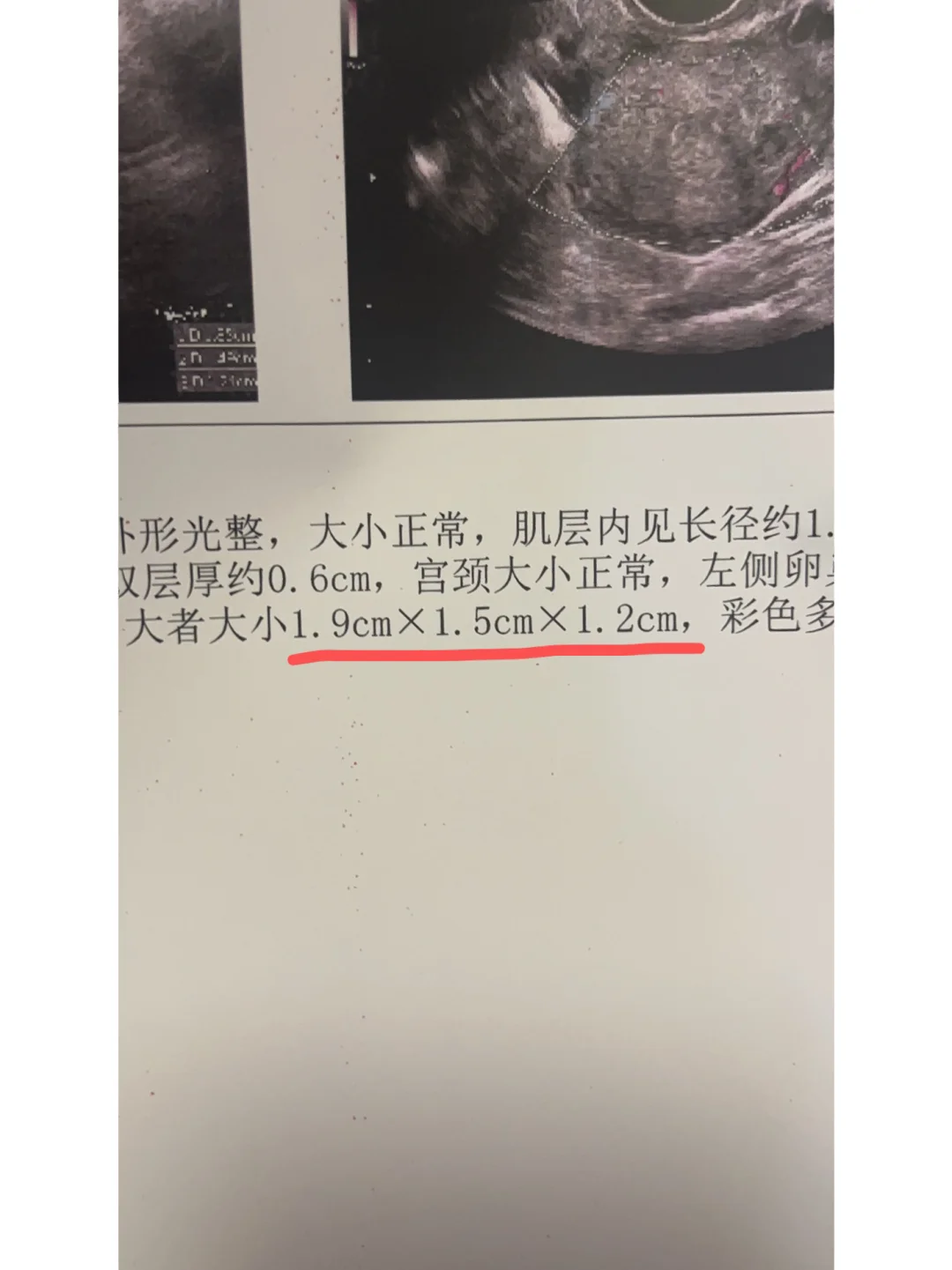 卵子质量差,长春洗精